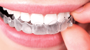 Rubber Bands Instructions  Braces Omaha - Orthodontics & Invisalign®